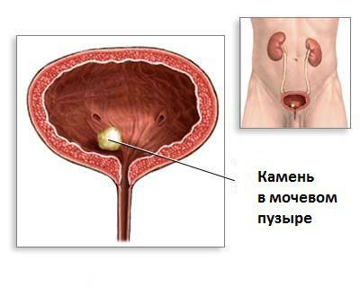 Камень мочевого пузыря