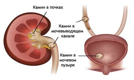 Камни в почках