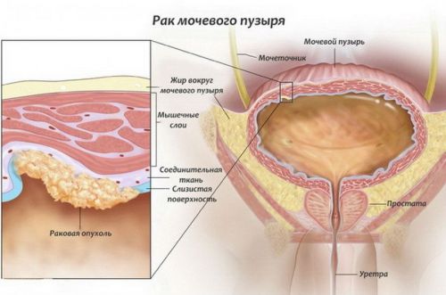 Рак мочевого пузыря