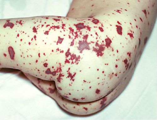 Менингококковая инфекция