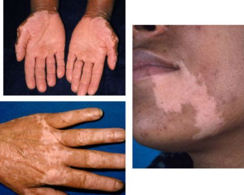 Пигментация кожных покровов при болезни Аддисона
