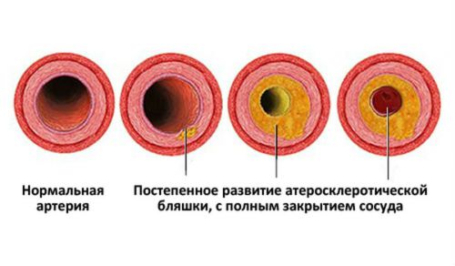 Атеросклероз артерий