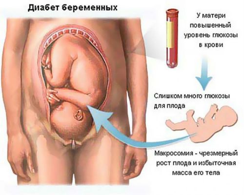 Диабет при беременности
