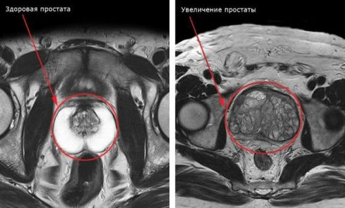 Аденома на МРТ