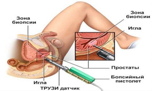 Биопсия простаты