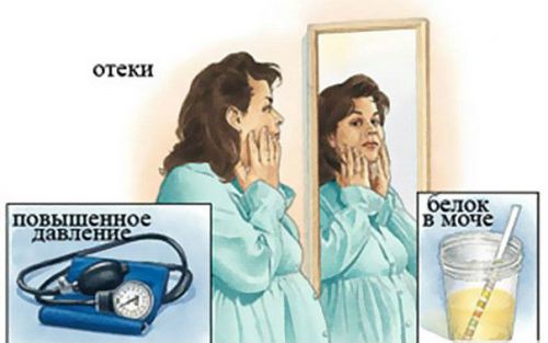 Симптомы гестоза при беременности