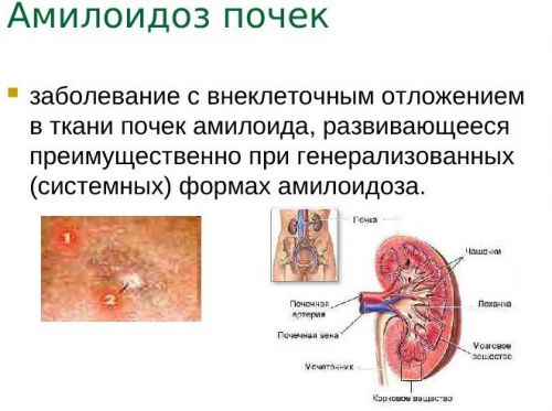 Амилоидоз почек