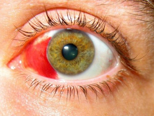 Кровоизлияние в глазу