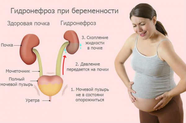 Гидронефроз при беременности