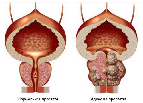 Аденома простаты