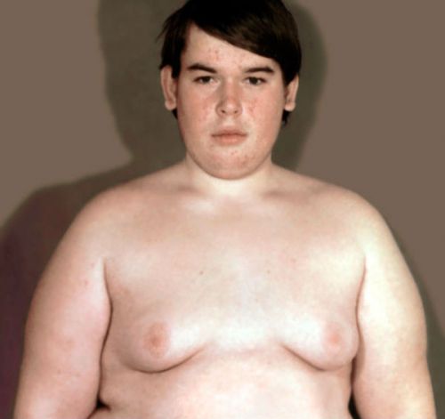 Ожирение по женскому типу у мужчины