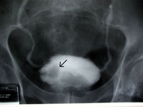 Рак мочевого пузыря на рентгене