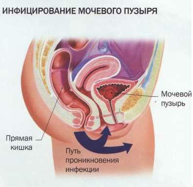 Инфекция мочевого пузыря
