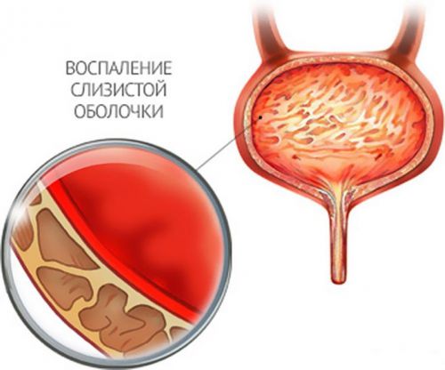 Воспаление слизистой оболочки