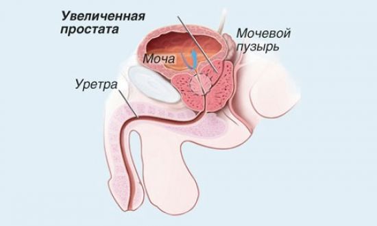 Увеличенная простата