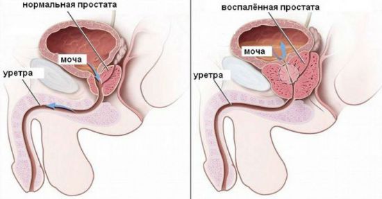 Простатит