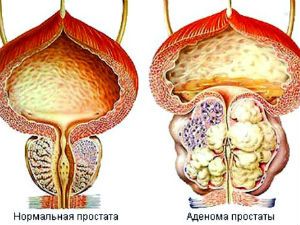 Аденома простаты