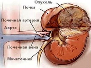 Опухоль почки