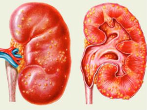 Апостематозный пиелонефрит