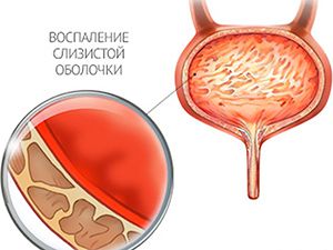 воспаление мочевого пузыря