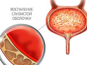 Воспаление мочевого пузыря