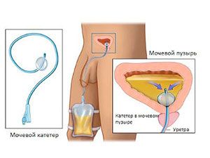 цистома и мочевой пузырь