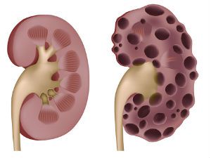 Кистозная дисплазия почек