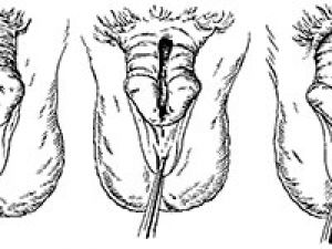 эписпадия у мужчин
