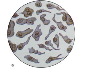 Клетки эпителия в моче