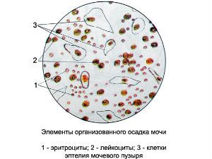 Форменные элементы в моче