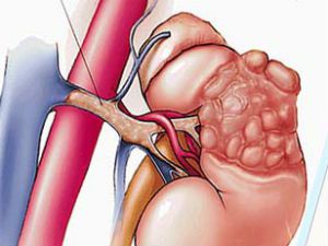 Гемангиома почки