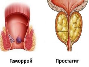 Геморрой и простатит