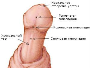 Виды гипоспадии