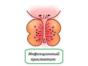 Инфекционный простатит