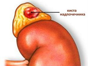 Киста надпочечника