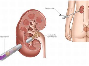 почка и нефростома
