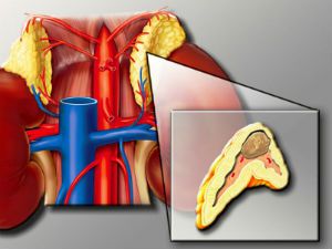 Опухоль надпочечника