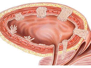 полип в  мочевом пузыре