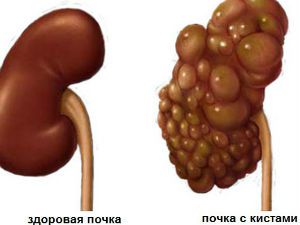 Поликистоз почек