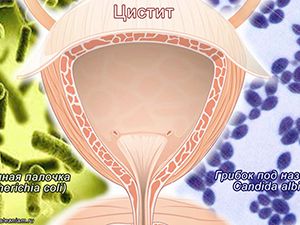 воспаленный мочевой пузырь