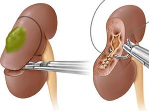Резекция почки