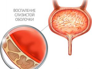 воспаление мочевого пузыря