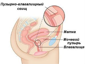 Пузырно-влагалищный свищ