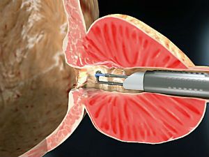 ТУР аденомы простаты
