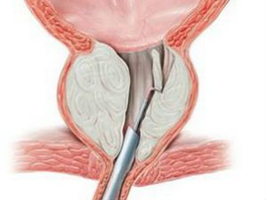 ТУР аденомы простаты