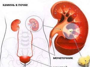 Камни в почках